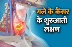 ये 6 संकेत दिखे तो समझिए गले में कैंसर के शुरुआत हो चुकी, देर हो इससे पहले डॉक्टर के पास जाएं, समय पर हो जाएगा इलाज